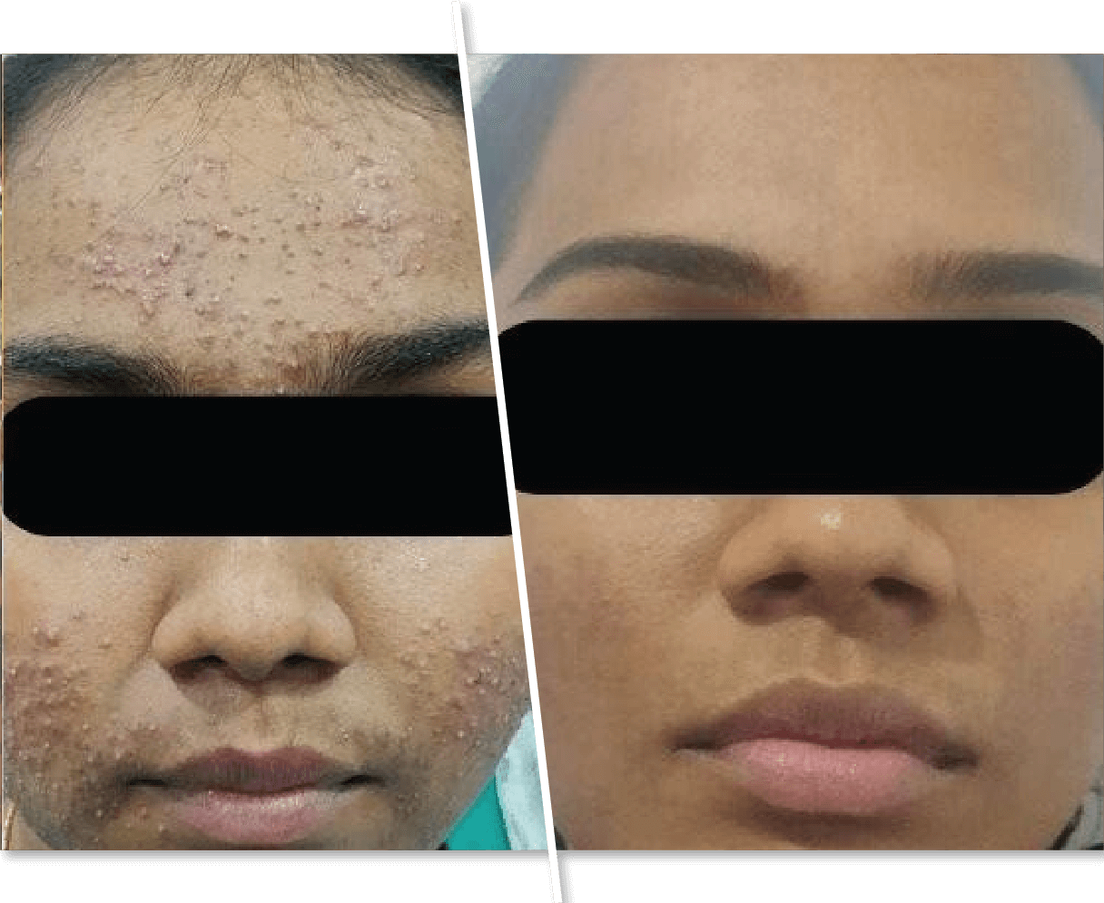 Woman Face Before and After Skin Treatment